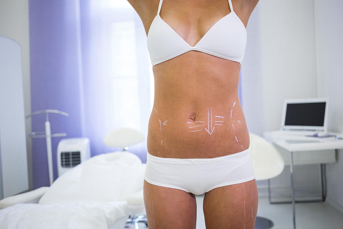 WHAT DIFFERENT TYPES OF LIPOSUCTION ARE THERE ?